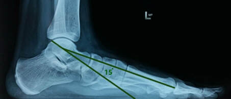 3 x 3 - What Can Cause Hip and Back Pain