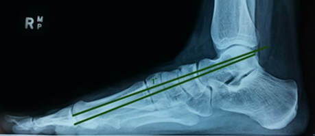 3 x 4 - What Can Cause Hip and Back Pain