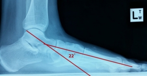 xray feet 2 300x155 - What Can Cause Hip and Back Pain