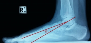 xray feet 3 300x145 - What Can Cause Hip and Back Pain