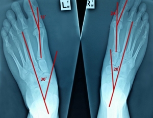 xray feet3 300x231 - What Can Cause Hip and Back Pain