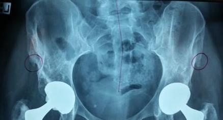 Misaligned Hips﻿ 2 - What Can Cause Hip and Back Pain