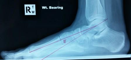 Misaligned Hips﻿ x rays 4 - What Can Cause Hip and Back Pain