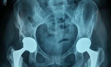 Misaligned Hips﻿ - What Can Cause Hip and Back Pain