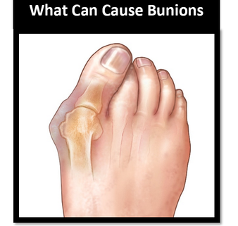 Podiatrist bunions on the Gold Coast