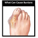 Podiatrist bunions on the Gold Coast