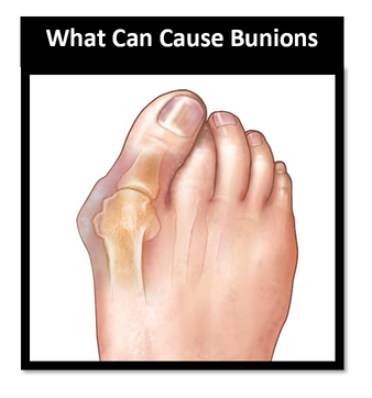 picture fb - What Can Cause Bunions