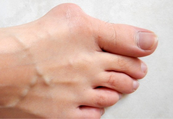 Bunion Pain Gold Coast Podiatrist - What Can Cause Bunions