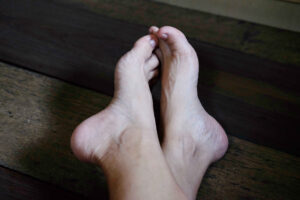 Insights Bunions blog 300x200 - Insights