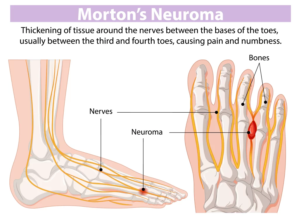 mortons neuroma